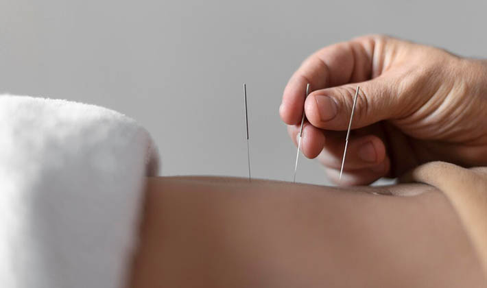 Como a Acupuntura pode ajudar quem tem câncer de mama